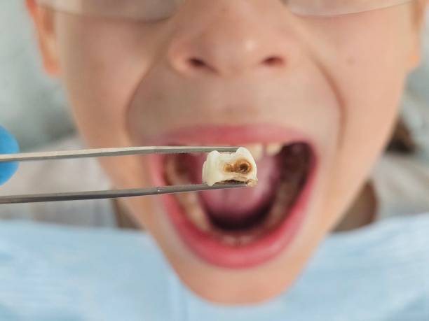 Best Emergency Root Canal Treatment in Montgomery, GA